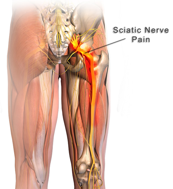 What Causes Sciatica and Buttock Pain? – Neuragenex